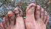 Beth McCurdy’s Destroyed Feet from Ancient Oaks 100